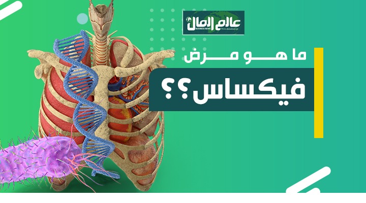 مرض فيكساس